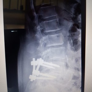 Spinal Fusion L4 L5 2 rods 4 screws May 2014 Sunnybrook Dr. V Yang.jpg